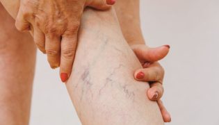 Varizes: Dicas e Tratamentos para Aliviar o Desconforto